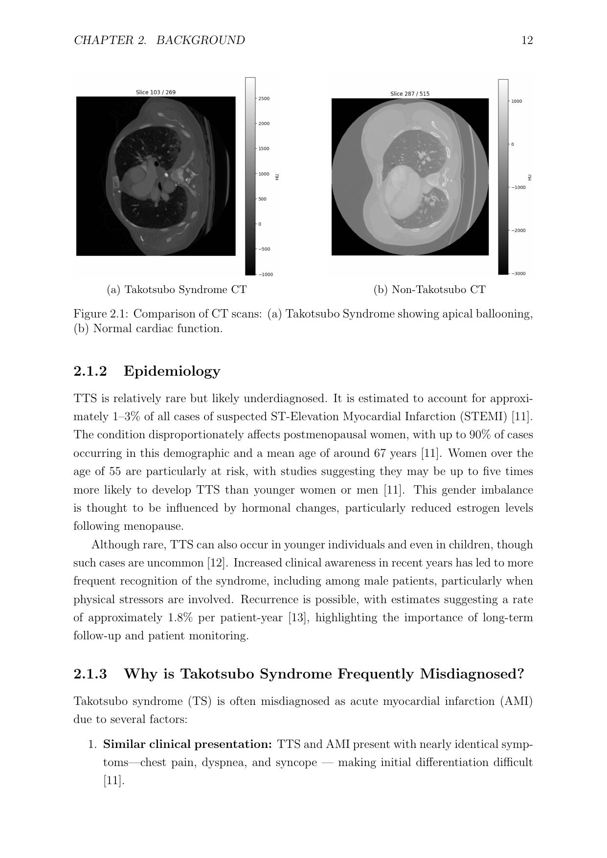 CT scan comparison: Takotsubo vs normal cardiac function